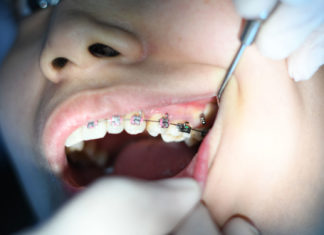 Now-It's-Proper-Time-to-Straighten-Your-Teeth-on-civicdaily